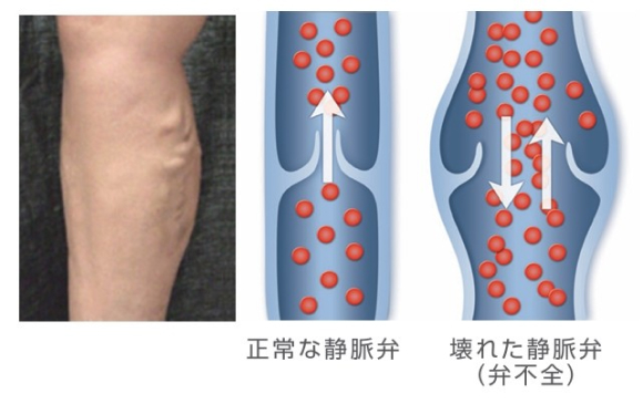 下肢静脈瘤患部の写真と血管の図